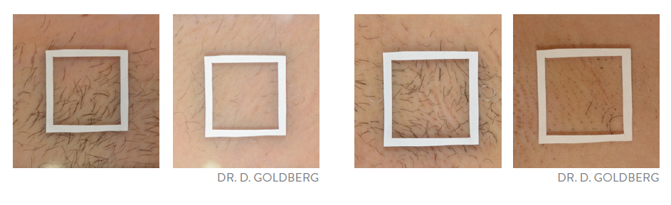 Before and after image for Diolaze