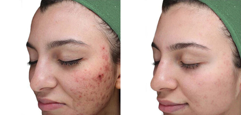 benefits of a VI Peel