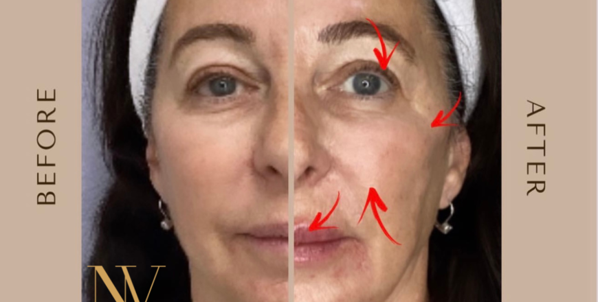 Full Face Rejuvenation