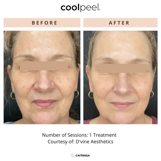 CoolPeel