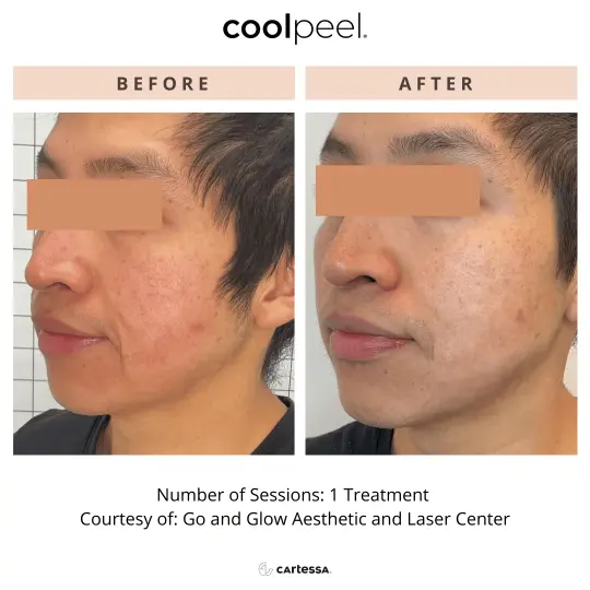 CoolPeel