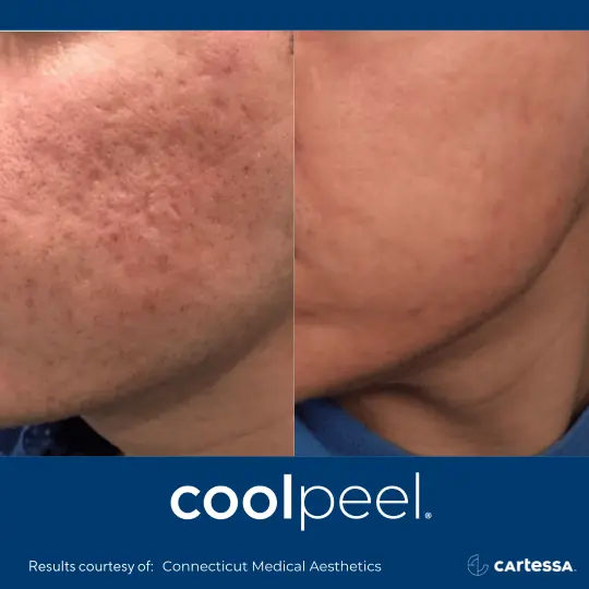 CoolPeelBACheek