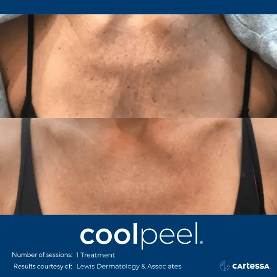 CoolPeelBADecollete