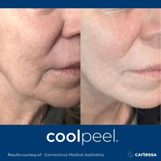 CoolPeelBAFemaleCheek