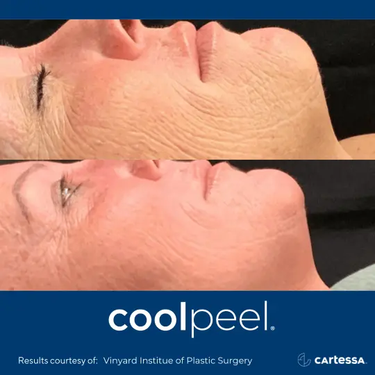 CoolPeelBAFemaleFace