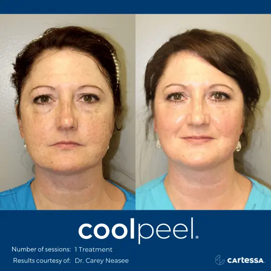 CoolPeelBAFemaleFaceFront