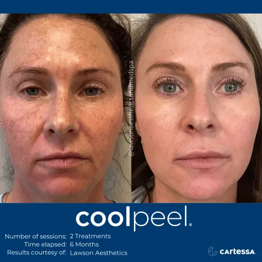CoolPeelLawsonAesBeforeAfter