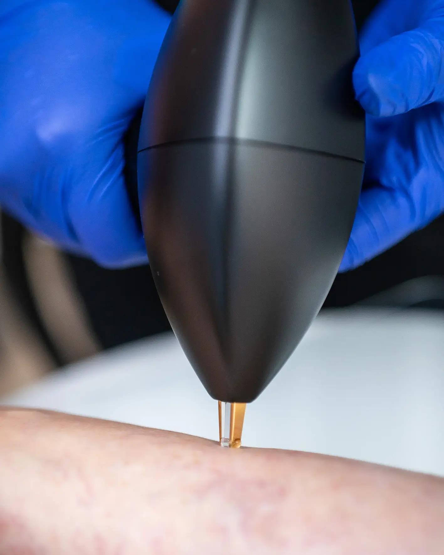 Vein Treatments