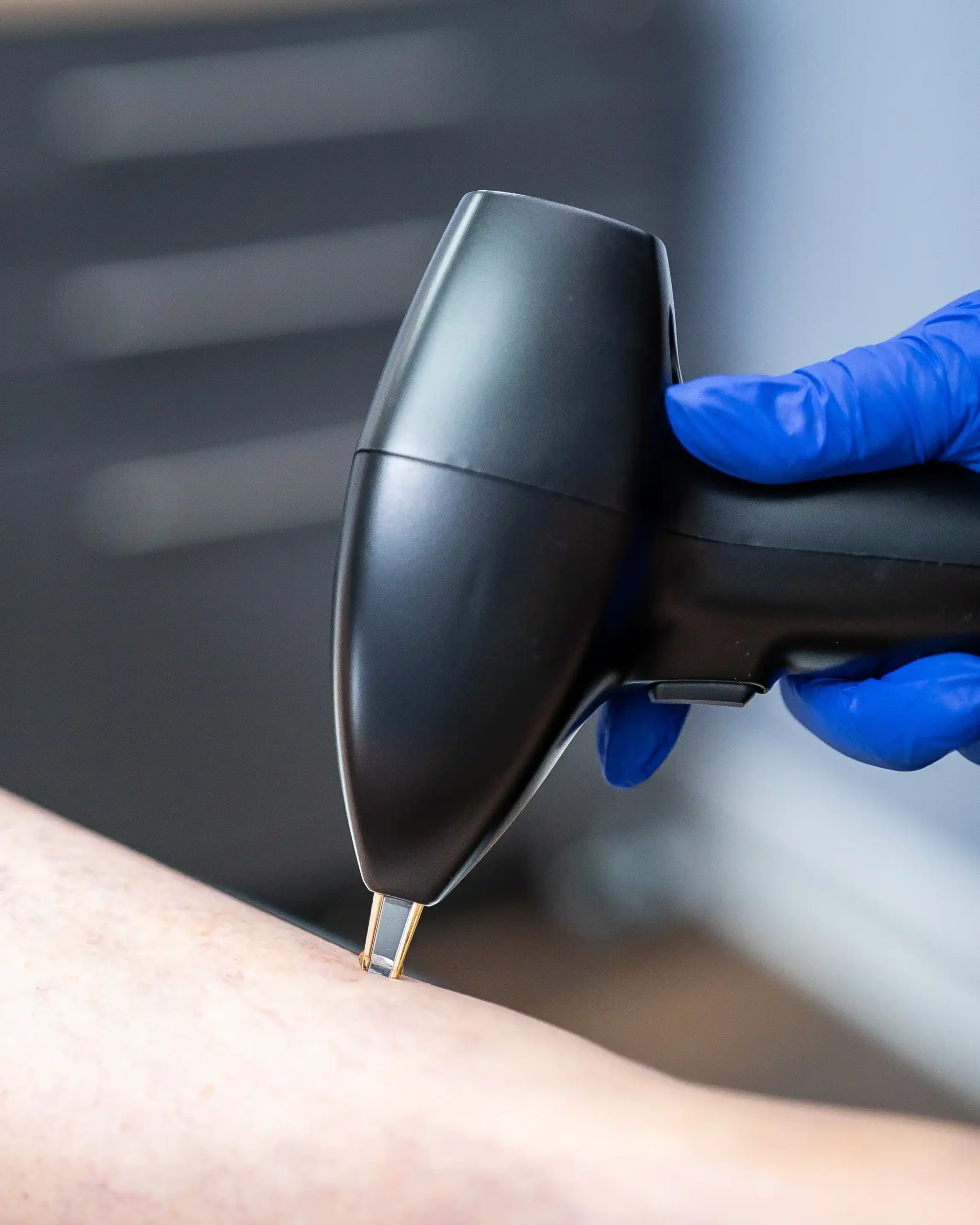 Vasculaze Treatment