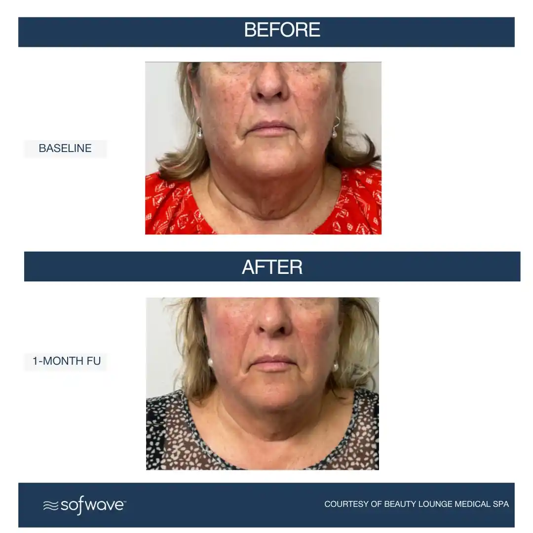 Set-100-Full-Face-Neck