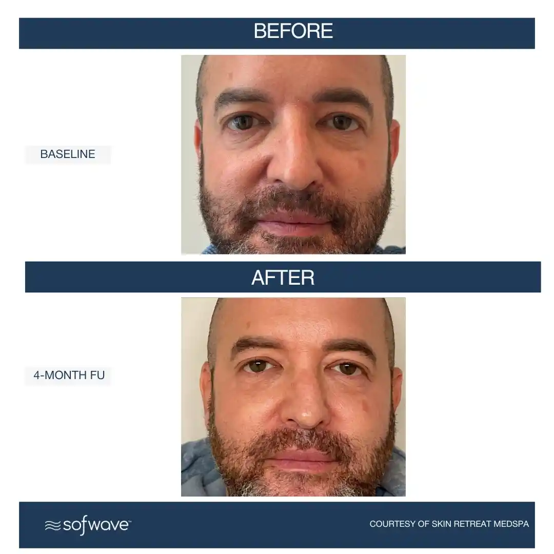 Set-103-Under-Eyes