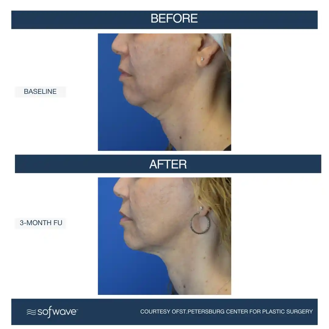Full-Face-Neck