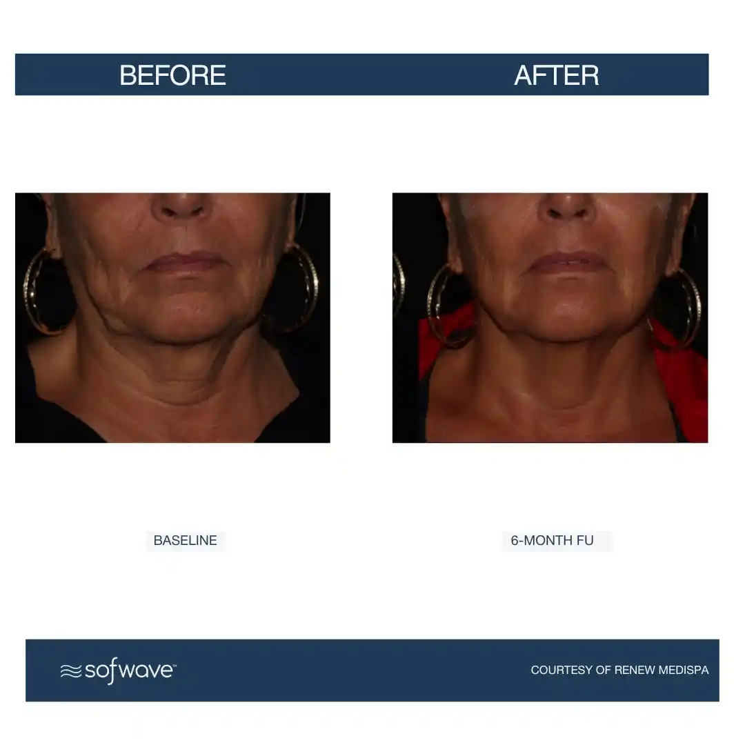 Set-85-Lower-Face-Neck