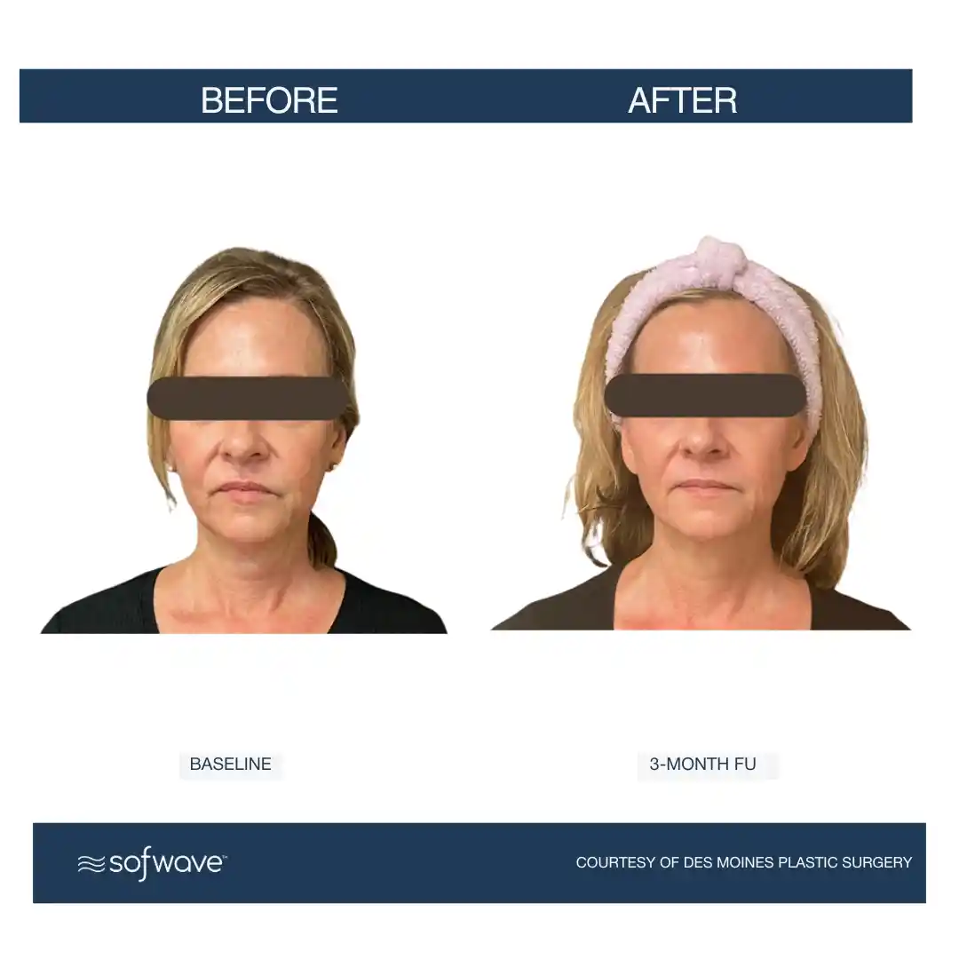 Set-89-Face-Neck