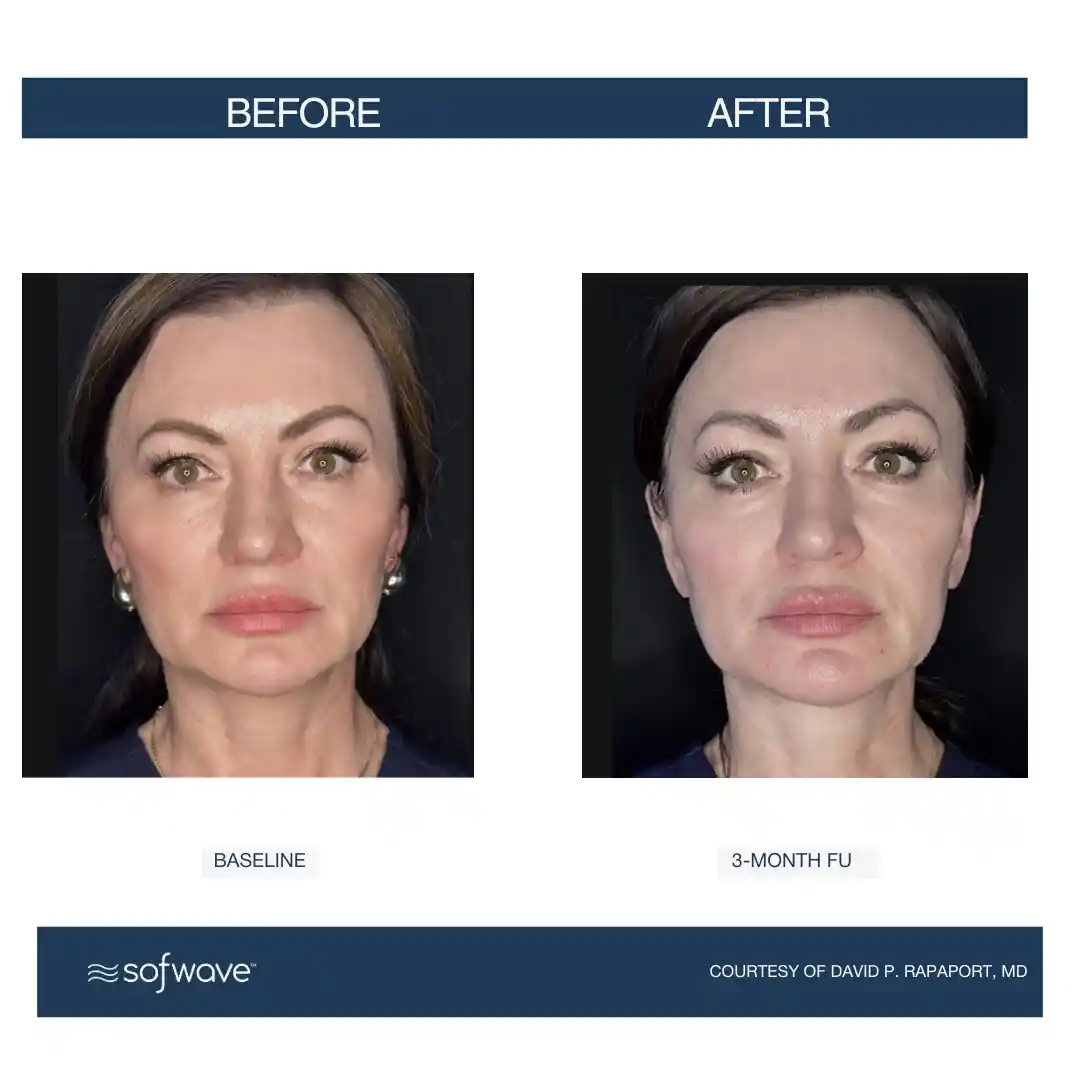 Set-90-Face-Submental