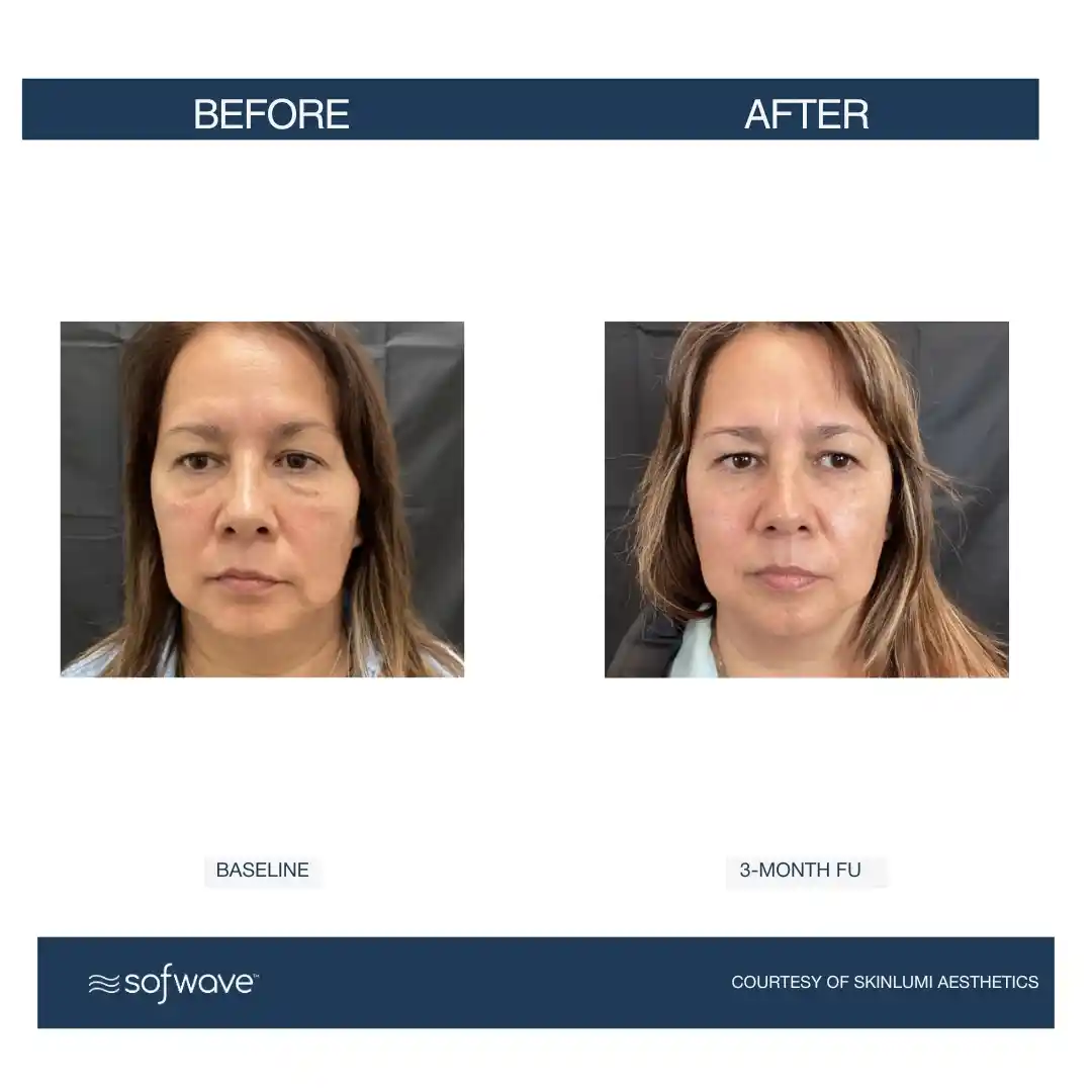 Set-91-Full-Face