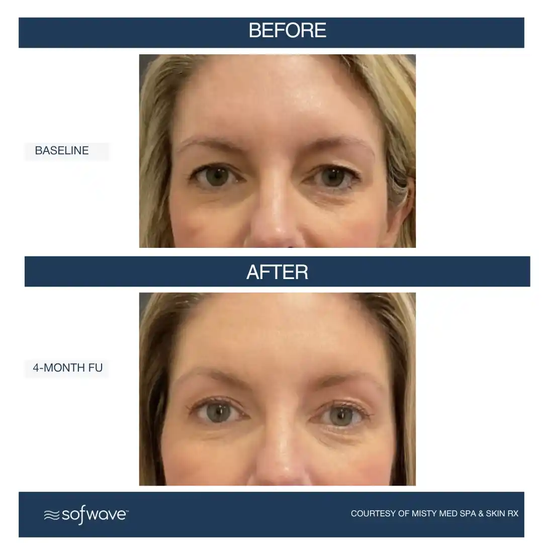 Set-93-Under-Eyes