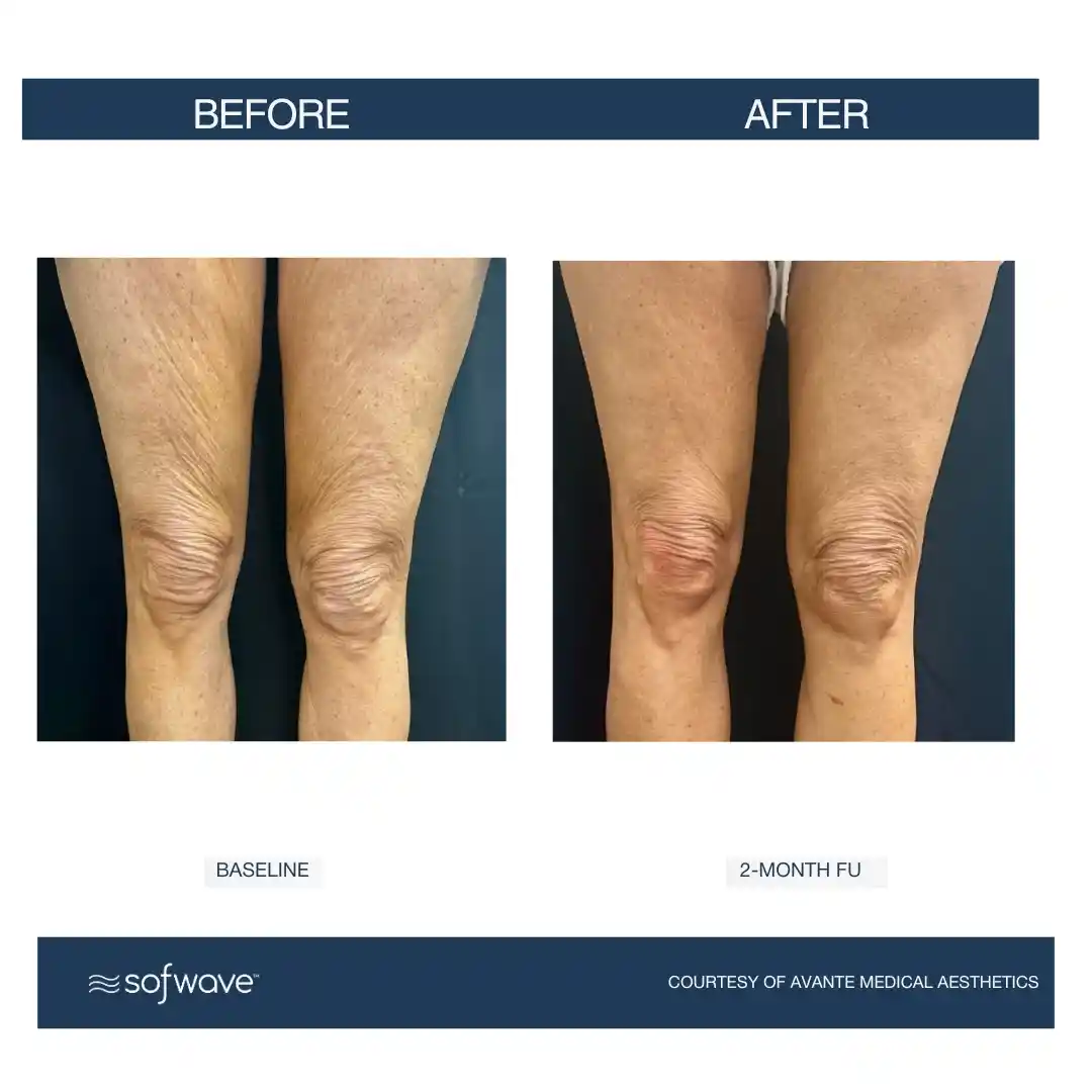 Set-99-Cellulite